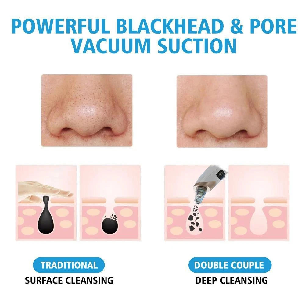 Face Blackhead Remover